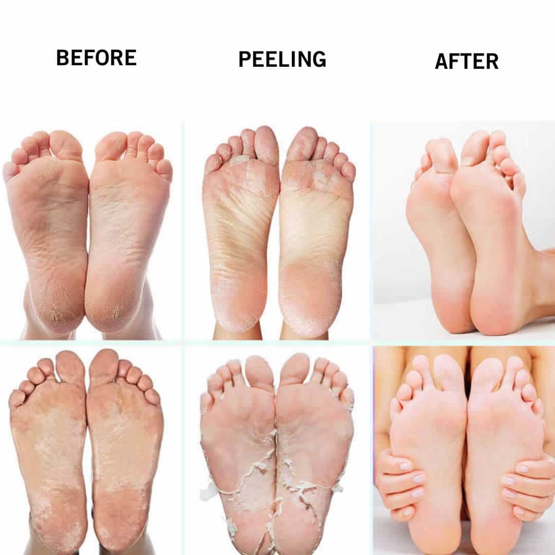 Foot Peel Mask Erfahrungen und Meinungen