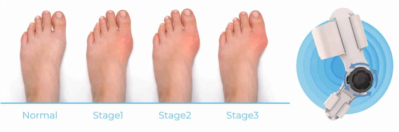 Best bunion corrector, reviews and opinions