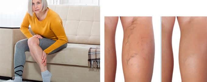How to get rid of varicose veins review and opinions