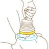 how lifevac works step 1