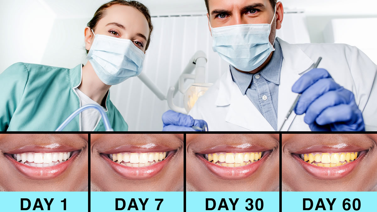 LaughLand teeth whitening LaughLand teeth whitening kit