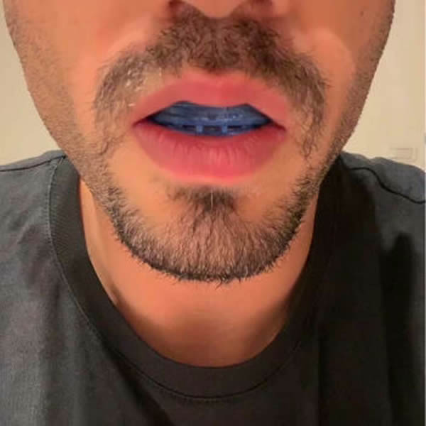 SleepZee antisnoring mouthpieze real user SleepZee antisnoring mouthpieze real user