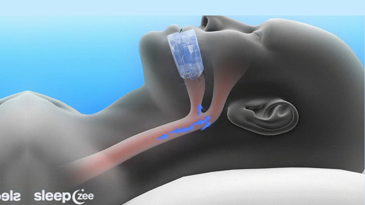 Sleepzee antisnoring reviews and opinions Sleepzee antisnoring reviews and opinions